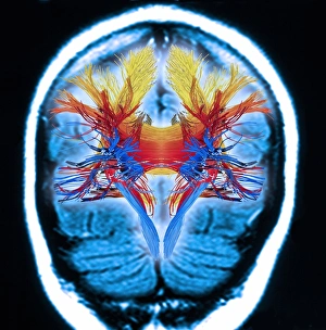 White matter fibres, brain mri scan C018/6386 White matter fibres, brain mri scan C018/6386