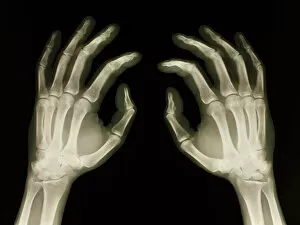 Images Dated 5th August 2005: X-ray of healthy human hands