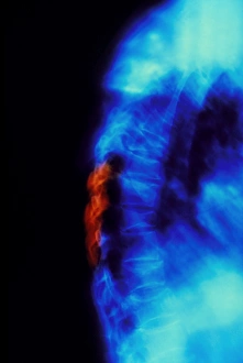 X-ray of osteoporosis of the thoracic spine X-ray of osteoporosis of the thoracic spine