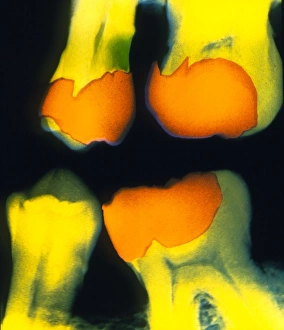 Dental X Ray Prints: X-ray of teeth