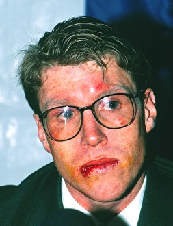 Australia captain Nick Farr-Jones shows his battle scars after the 3rd Test - 1989 British Lions Tour to Australia Australia captain Nick Farr-Jones shows his battle scars after the 3rd Test - 1989 British Lions Tour to Australia