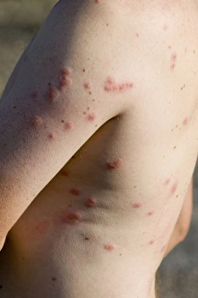 Midge Bites Print on Man