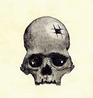 Trephination evidence in an Inca skull Trephination evidence in an Inca skull