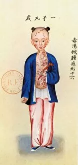 ChineseArt Collection: Chinese girl suffering from smallpox: watercolor