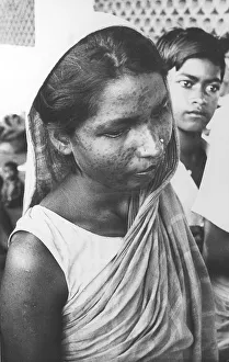 Indian woman with Smallpox scars Indian woman with Smallpox scars