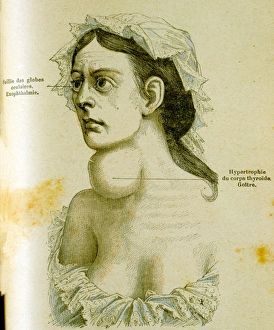 Woman with goitre, Enlargement of thyroid gland Woman with goitre, Enlargement of thyroid gland