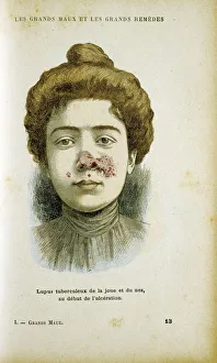 Woman suffering from Lupus Vulgaris Woman suffering from Lupus Vulgaris