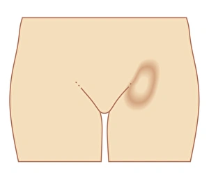 Biomedical illustration of femoral hernia in female Biomedical illustration of femoral hernia in female