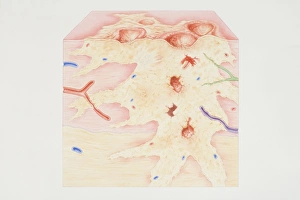 Cross-section diagram of a cancerous tumour including calcium deposits, blood vessels, tumour outgrowth Cross-section diagram of a cancerous tumour including calcium deposits, blood vessels, tumour outgrowth