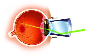 Cross section of eye ball, laser ray entering through pupil, directed at eye nerves Cross section of eye ball, laser ray entering through pupil, directed at eye nerves