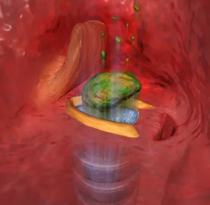 Digital cross section illustration of food entering the trachea the wrong way Digital cross section illustration of food entering the trachea the wrong way