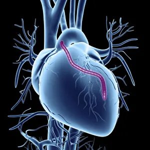 Heart bypass graft, artwork Heart bypass graft, artwork