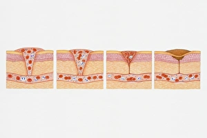 Illustration of formation of blood clot in series of four cross section illustrations Illustration of formation of blood clot in series of four cross section illustrations