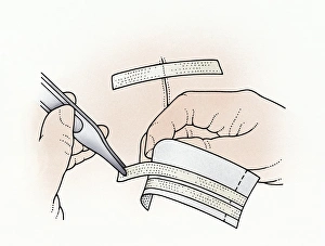 Illustration showing removal of butterfly stitches from adhesive paper using tweezers to apply to wound Illustration showing removal of butterfly stitches from adhesive paper using tweezers to apply to wound