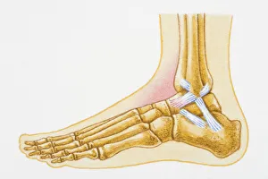 Illustration showing swollen talocrural joint caused by sprain to anterior talofibular Illustration showing swollen talocrural joint caused by sprain to anterior talofibular