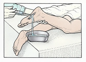 Illustration of using syringe to clean wound on sole of foot Illustration of using syringe to clean wound on sole of foot
