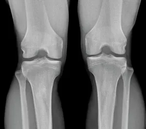 Human Body Prints: Normal Knees X-ray Print: Anatomical Study