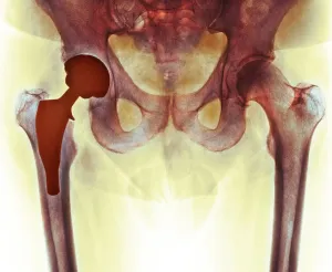 Coloured X-ray of Total Hip Replacement Print