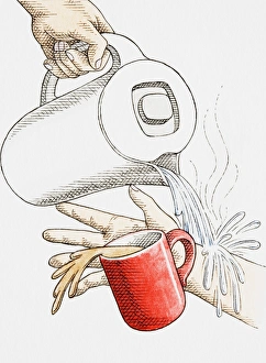 Scolding by accidentally pouring boiling hot water from modern kettle onto arm, causing mug of coffee to fall Scolding by accidentally pouring boiling hot water from modern kettle onto arm, causing mug of coffee to fall