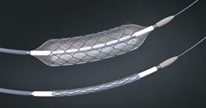 Stents and balloon catheters, illustration Stents and balloon catheters, illustration