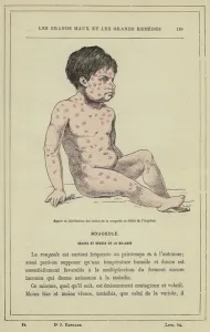 Aspect et distribution des taches de la rougeole au debut de l' Aspect et distribution des taches de la rougeole au debut de l'
