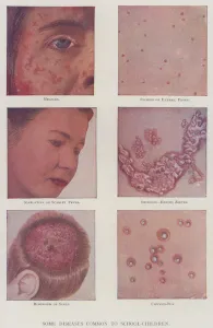 Some Diseases Common to School-Children (colour photo) Some Diseases Common to School-Children (colour photo)