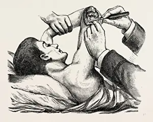 Medical Equipment History Prints: excision of the elbow, the clearing of the humerus, medical equipment, surgical instrument