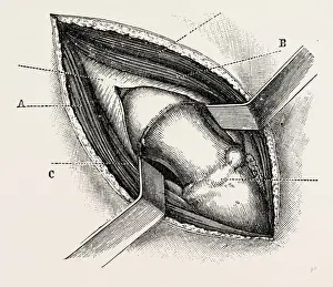 Medical Equipment History Prints: excision of the hip by an external incision, medical equipment, surgical instrument