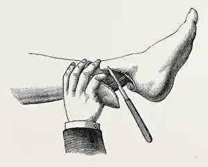 Medical Equipment History Prints: mode of dividing the tissues in the amputation, medical equipment, surgical instrument