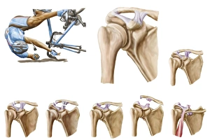 Anatomy of acromioclavicular joint rupture and displacement Anatomy of acromioclavicular joint rupture and displacement