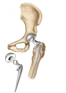 Hip Replacement Surgery Print