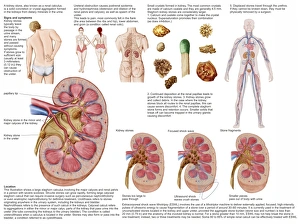 Medical chart showing the signs and symptoms of kidney stones Medical chart showing the signs and symptoms of kidney stones