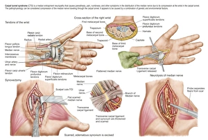Medical illustration showing carpal tunnel syndrome in the human wrist Medical illustration showing carpal tunnel syndrome in the human wrist