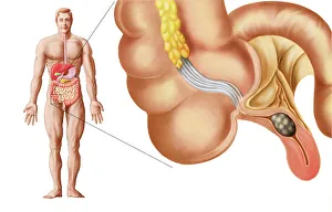 Medical ilustration of an appendix with appendicitis Medical ilustration of an appendix with appendicitis