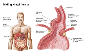 Medical ilustration of a hiatal hernia in the upper part of the stomach into the thorax Medical ilustration of a hiatal hernia in the upper part of the stomach into the thorax
