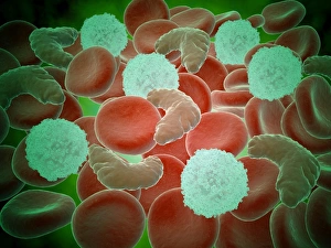 Sickle cell anemia with red blood cells and white bood cells Sickle cell anemia with red blood cells and white bood cells