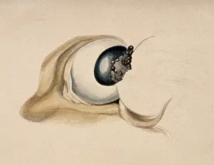 Anatomy Of The Eye Prints: A diseased eye. Creator: Unknown