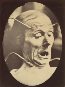 Duchenne de Boulogne's Figure 62: Semiprofile Print, 1862