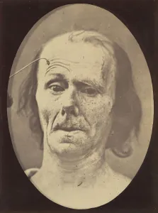 Figure 9: A study of m. frontalis in maximum contraction, 1854-56, printed 1862
