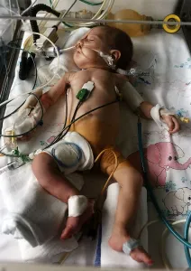 Zenaida Agic sleeping peacefully in the incubator. She was airlifted out of Sarajevo Zenaida Agic sleeping peacefully in the incubator. She was airlifted out of Sarajevo