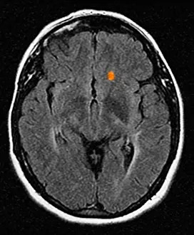 Framed Print : Multiple Sclerosis Brain CT Scan Print Framed Print : Multiple Sclerosis Brain CT Scan Print