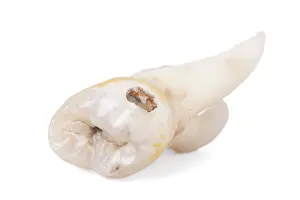 Pulled Wisdom Tooth Prints: Pulled wisdom tooth, tooth, carious