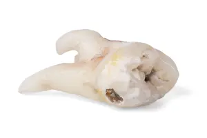 Pulled Wisdom Tooth Prints: Pulled wisdom tooth, tooth, carious