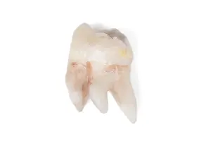 Bright Light Photography Prints: Pulled wisdom tooth, tooth, carious