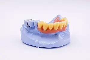 Dentist Treatment Prints: Removable denture of an upper jaw