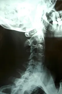 Cervical Vertebrae Prints: X-ray