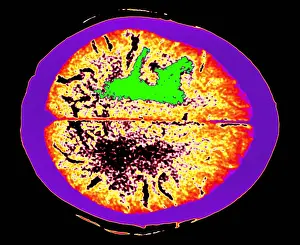 Computed Tomography Scans Prints: Brain edema