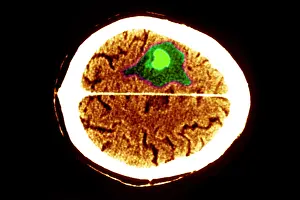 Framed Print : Brain Edema Print: Color Enhanced CT Scan of a Brain Tumor Framed Print : Brain Edema Print: Color Enhanced CT Scan of a Brain Tumor