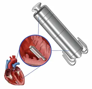 Leadless Pacemaker Print