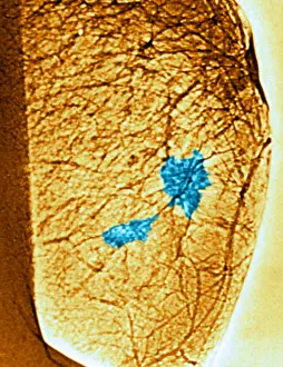 Medical Imaging Techniques Prints: Mammogram
